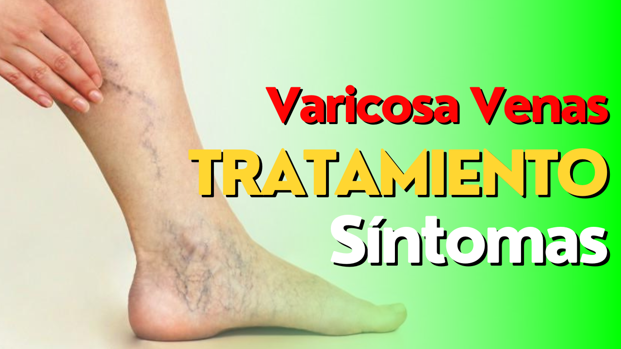 Venas varicosas