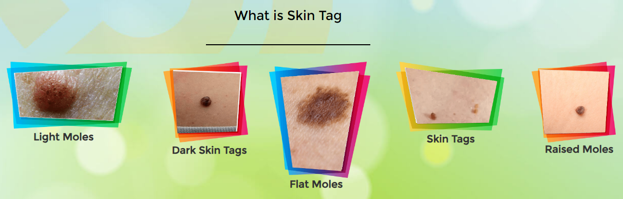 What is Skin Tag