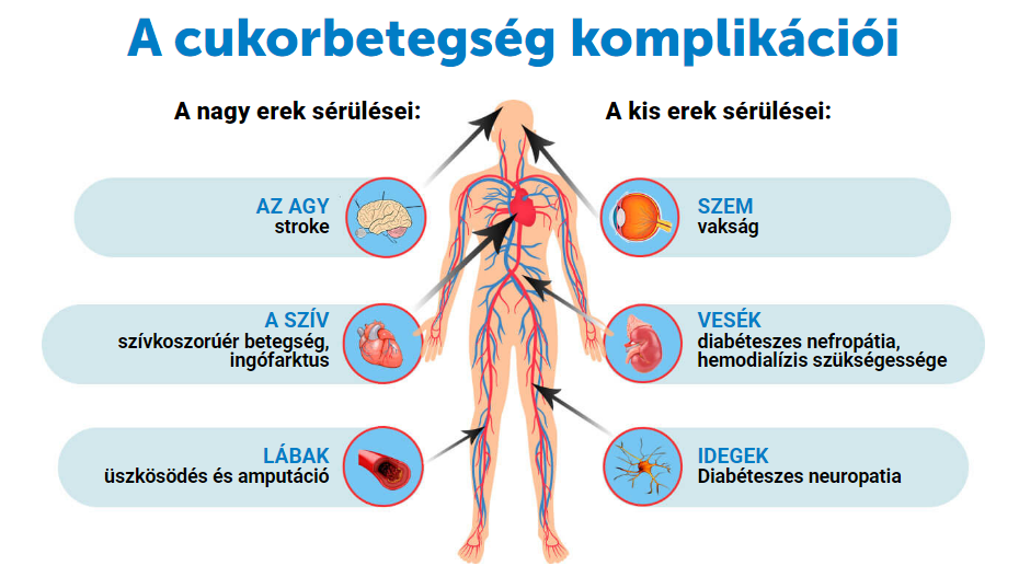 A cukorbetegség komplikációi